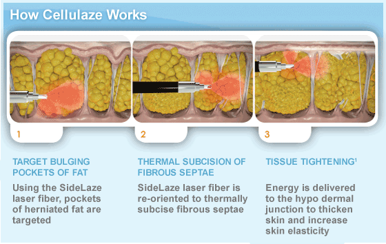 Cellulaze Cellulite treatment in Pearland