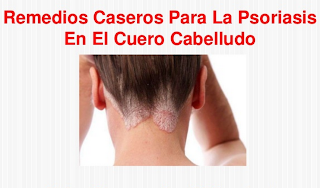 Psoriasis-Del-Cuero-Cabelludo-Tratamiento-Natural-Remedios-Caseros