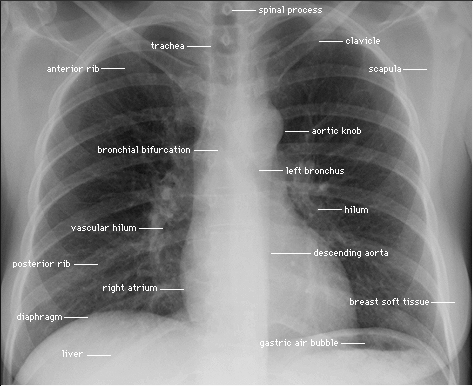 sides of the chest X-ray