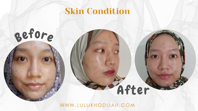 Before After Penggunaan BASE Skincare