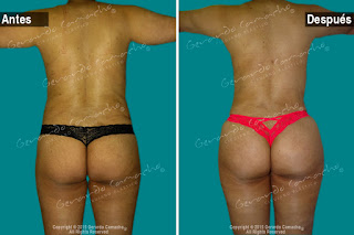 Brazilian-Buttliff-Lipotransferencia