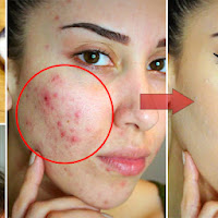 See How This Women Remove Acne And Spots In Just 10 Minutes, But How?