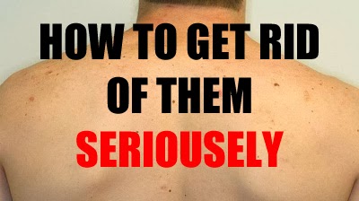 How to Get Rid of Back Acne Scars Fast at Home