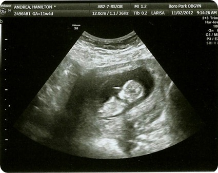 Twin B 12 weeks
