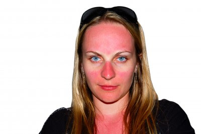 Gesichtsbehandlung nach Sonnenbrand