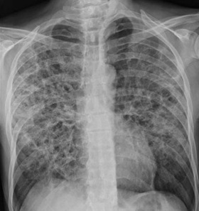 Radiologia. Polmoni infestati da Pneumocystis