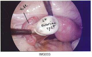 ovarian cyst viewed by laparoscope