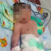 Bayi Yang Lahir Dengan Satu Mata dan Tidak Ada Hidung di Indonesia, Diduga Karena Merkuri