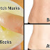 How To Erase Stretch Marks in 4 Weeks  Quick & Easy  100% Works