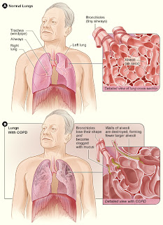 COPD Nursing Care Plan