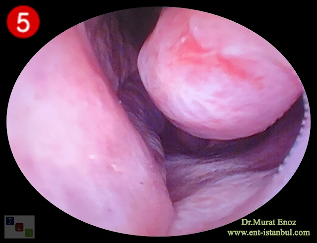 1 Week After Left Inferior Turbinate Medialization