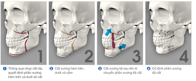 Phẫu thuật hàm hô móm khi nào?