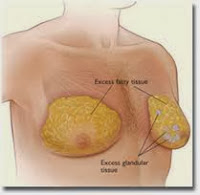 Exercice pour se  débarrasser de seins homme