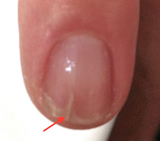 Fingernagel Verletzungen. Fingernagel stinkt nach Quetschung. Jenn Cosmetic.