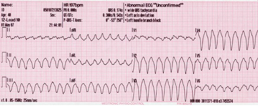 心室頻脈 Ventricular tachycardia, VT