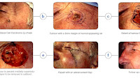 Melanoma - Most Dangerous Cancer