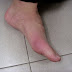 How To Cure Gout Pain From Home : Relieve Gout Pain Naturally