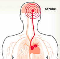 Obat Stroke Alami, Ampuh Menyembuhkan Stroke dg Aman Tanpa Efek Samping