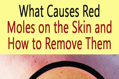 What Causes Red Moles on the Skin and How to Remove Them