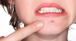 What Causes Acne?