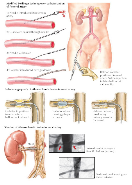 ENDOVASCULAR THERAPIES FOR RENAL ARTERY STENOSIS