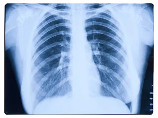 Can a chest xray show mesothelioma?