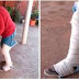 Médico enfaixa perna quebrada sobre a roupa de paciente