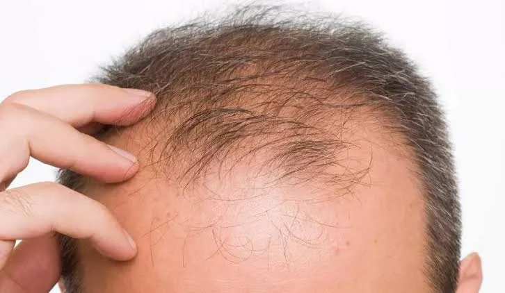 Inilah Beberapa Tips Mencegah Rambut dari Kebotakan dan Menjaga agar Tetap Sehat