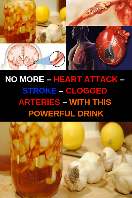 No More – Heart Attack – Stroke – Clogged Arteries – With This Powerful Drink