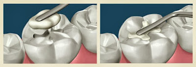 Phương pháp trám răng Composite