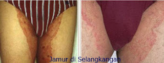 Jual Obat Gatal Kurap Di Selangkangan Dan Pantat