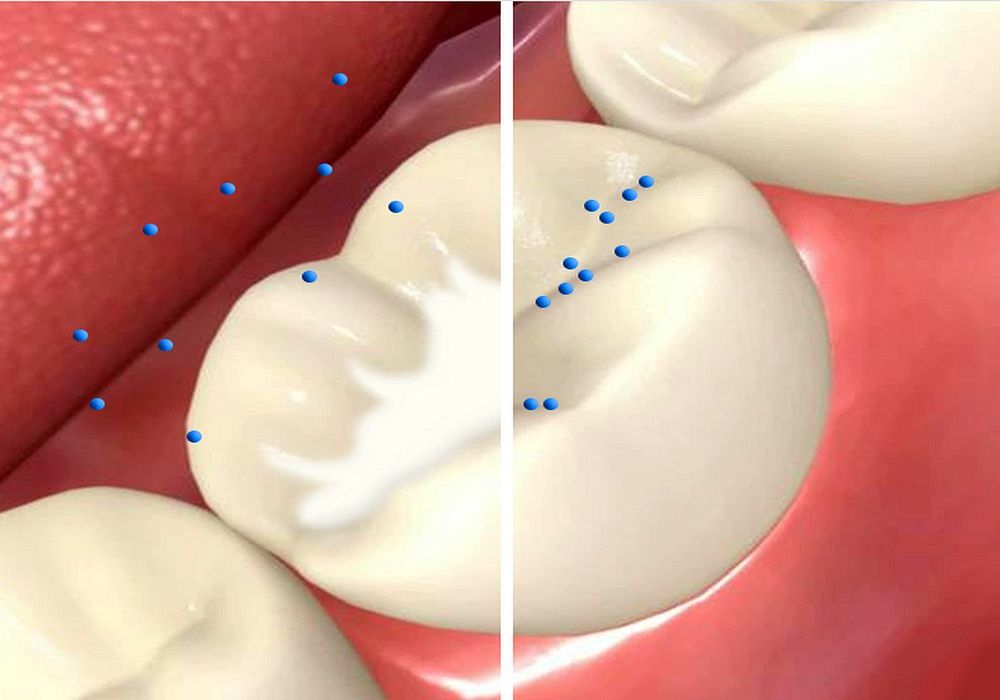 Dental Sealants