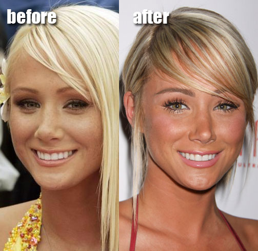 Sara Jean Underwood before and after nose job plastic surgery.