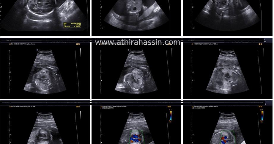 Beza scan baby 2D 3D 4D 5D dan HD - athirahassin