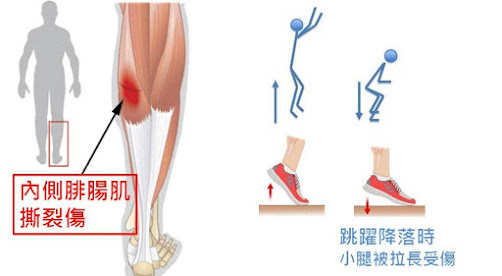 #小腿痛 #網球腿 #網球腿 PRP #小腿肌肉撕裂 #肌肉撕裂PRP #肌肉啪一聲  #李嘉瑋醫師