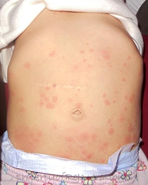 Amoxicillin Allergic Reaction. an allergic reaction to