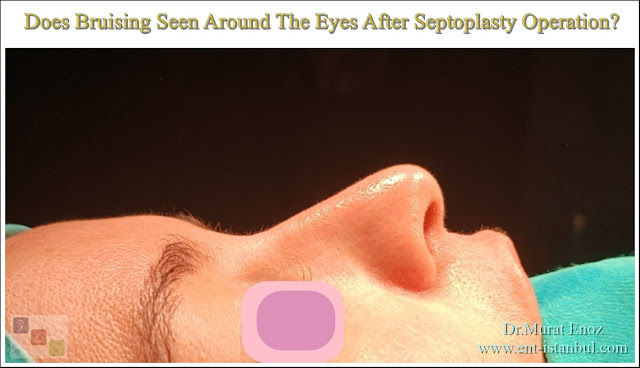 Will eye bruise be seen after septoplasty?,Bruising after septoplasty operation?,Did eyes after septoplasty surgery is bruising?,Do you see bruising and edema around the eye after a septoplasty?,