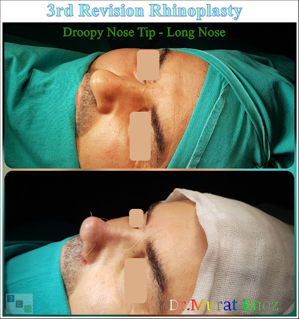 3rd Revision Rhinoplasty - Droopy Nose Tip - Tertiary Nose Job For Men