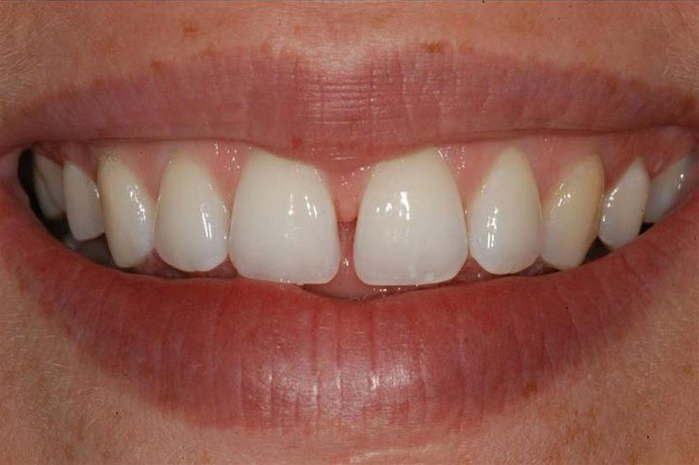 Diastema