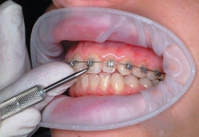 Niềng răng điều trị hô