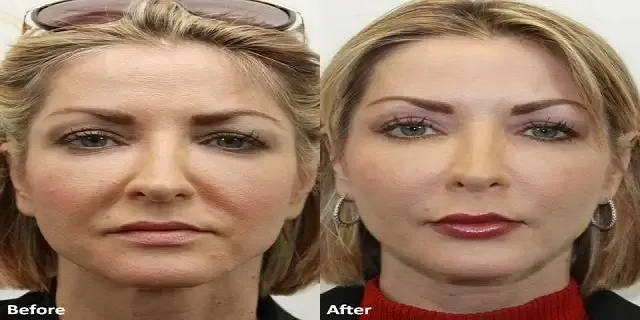 حقن الدهون الذاتية في الوجه قبل وبعد: دليل شامل حول العملية