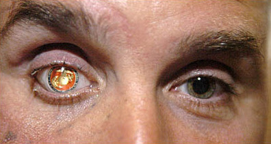 Nicholas Popaditch's prosthetic eye