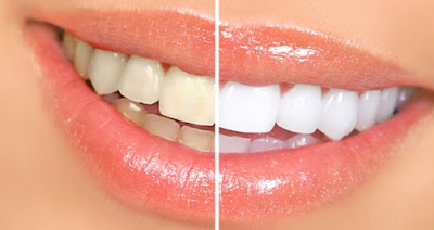 Memiliki gigi putih higienis tentu harapan setiap orang 9 Cara Unik & Sederhana Untuk Memutihkan Gigi Secara Alami