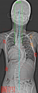 脊椎側彎, 脊椎側彎矯正, 脊椎側彎治療, 脊椎側彎矯正運動, 脊椎側彎矯正成功案例, 脊椎側彎 瑜珈
