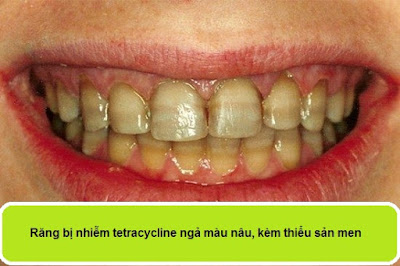 Răng bị nhiễm tetracycline ngả màu nâu, kèm thiểu sản men
