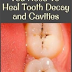 The Only 6 Natural Remedies You Need To Heal Tooth Decay and Cavities ...