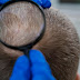 Causes, Treatment Options, and Coping Strategies for Male-Pattern Baldness