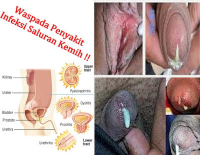 artikel penyembuhan kencing nanah, pengobatan antibiotik kencing nanah, penyembuhan penyakit kencing nanah secara alami, cara penyembuhan kencing nanah pada pria, cara penyembuhan kencing nanah raja singa, pengobatan kencing nanah di bandung, pengobatan kencing nanah di medan, pengobatan kencing nanah di bali, pengobatan kencing nanah dengan propolis, pengobatan kencing nanah dengan antibiotik, pengobatan kencing nanah dokter, pengobatan kencing nanah di surabaya, pengobatan kencing nanah dengan penyuntikan, pengobatan kencing nanah di jogja, fase penyembuhan kencing nanah, pengobatan gejala kencing nanah, pengobatan herbal kencing nanah, pengobatan kencing nanah kaskus, lama penyembuhan kencing nanah, pengobatan kencing nanah medis, masa penyembuhan kencing nanah, obat penyembuhan kencing nanah, penyembuhan kencing nanah tanpa obat, penyembuh penyakit kencing nanah, penyembuhan penyakit kencing nanah, cara penyembuhan penyakit kencing nanah pada wanita, penyembuhan total penyakit kencing nanah, pengobatan kencing nanah pada pria, pengobatan kencing nanah pada wanita, pengobatan kencing nanah pada wanita hamil, pengobatan kencing nanah pada ibu hamil, pengobatan penyakit kencing nanah pada wanita, pengobatan penyakit kencing nanah kesehatan, pengobatan penyakit kencing nanah secara alami, pengobatan penyakit kencing nanah secara medis, cara penyembuhan penyakit kencing nanah, cara penyembuhan penyakit kencing nanah pada pria, proses penyembuhan penyakit kencing nanah, pengobatan kencing nanah secara alami, pengobatan kencing nanah secara medis, pengobatan kencing nanah secara tradisional, cara penyembuhan penyakit kencing nanah secara alami, pengobatan kencing nanah terbaru, pengobatan kencing nanah tradisional, cara penyembuhan kencing nanah tanpa obat, tanda penyembuhan kencing nanah, pengobatan untuk kencing nanah, pengobatan kencing nanah untuk ibu hamil, lama pengobatan kencing nanah, lama penyembuhan penyakit kencing nanah, berapa lama penyembuhan kencing nanah, lama penyembuhan penyakit kencing nanah, berapa lama pengobatan kencing nanah,berapa lama penyembuhan kencing nanah sampai tuntas, berapa lama penyembuhan kencing nanah, penyembuhan kencing nanah sampai tuntas, penyembuhan kencing nanah, lama penyembuhan kencing nanah, kencing nanah sampai tuntas, berapa lama penyembuhan kencing nanah, berapa lama kencing nanah sembuh, berapa lama penyembuhan penyakit kencing nanah, berapa lama proses penyembuhan kencing nanah, berapa lama pengobatan penyakit kencing nanah, berapa lama sembuh dari kencing nanah, berapa lama proses penyembuhan penyakit kencing nanah, berapa lama masa penyembuhan penyakit kencing nanah, penyembuhan kencing nanah pada pria, penyembuhan kencing nanah secara alami, penyembuhan kencing nanah secara medis, penyembuhan kencing nanah dengan, penyembuh kencing nanah, waktu penyembuhan kencing nanah, penyembuhan penyakit kencing nanah pada pria, ciri ciri penyembuhan kencing nanah, gejala dan penyembuhan kencing nanah, obat alami penyembuhan kencing nanah, cara penyembuhan kencing nanah, penyembuhan penyakit kencing nanah, tips penyembuhan kencing nanah, proses penyembuhan kencing nanah, cara penyembuhan kencing nanah pada wanita, cara penyembuhan kencing nanah secara alami, tahap penyembuhan kencing nanah, kumpulan penyembuhan kencing nanah, cara penyembuhan kencing nanah secara tradisional, terapi penyembuhan kencing nanah, pengobatan kencing nanah alami, menyembuhkan kencing nanah secara alami, pengobatan alternatif kencing nanah, pengobatan alternatif kencing nanah di jakarta, penyembuhan alami kencing nanah, Apa Obat Kencing Sakit Dan Keluar Nanah Untuk Pria Dan Wanita 