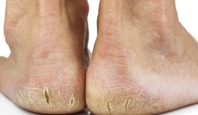 No more cracked heels and calluses