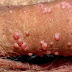 Ciri Virus Hepatitis B thumbnail